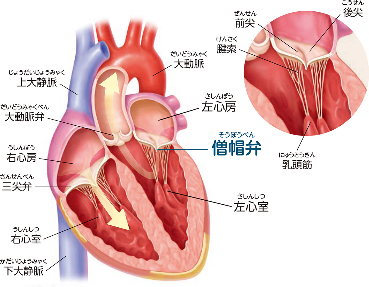僧帽弁閉鎖不全症の原因